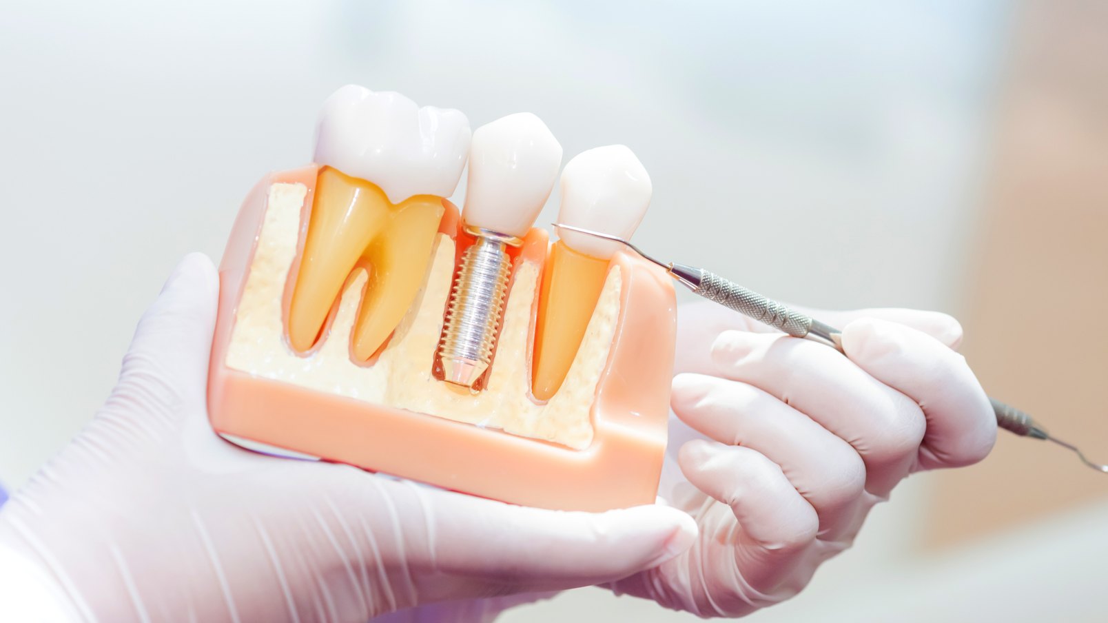 Gloved hands hold a jaw model showing a dental implant, with a dental instrument pointing at it.