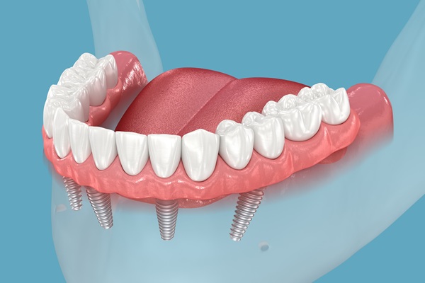 How Long Do All On   Implants Last?