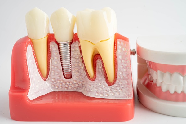 Dentures Vs  Dental Implants: Which Is The Right Choice For You?